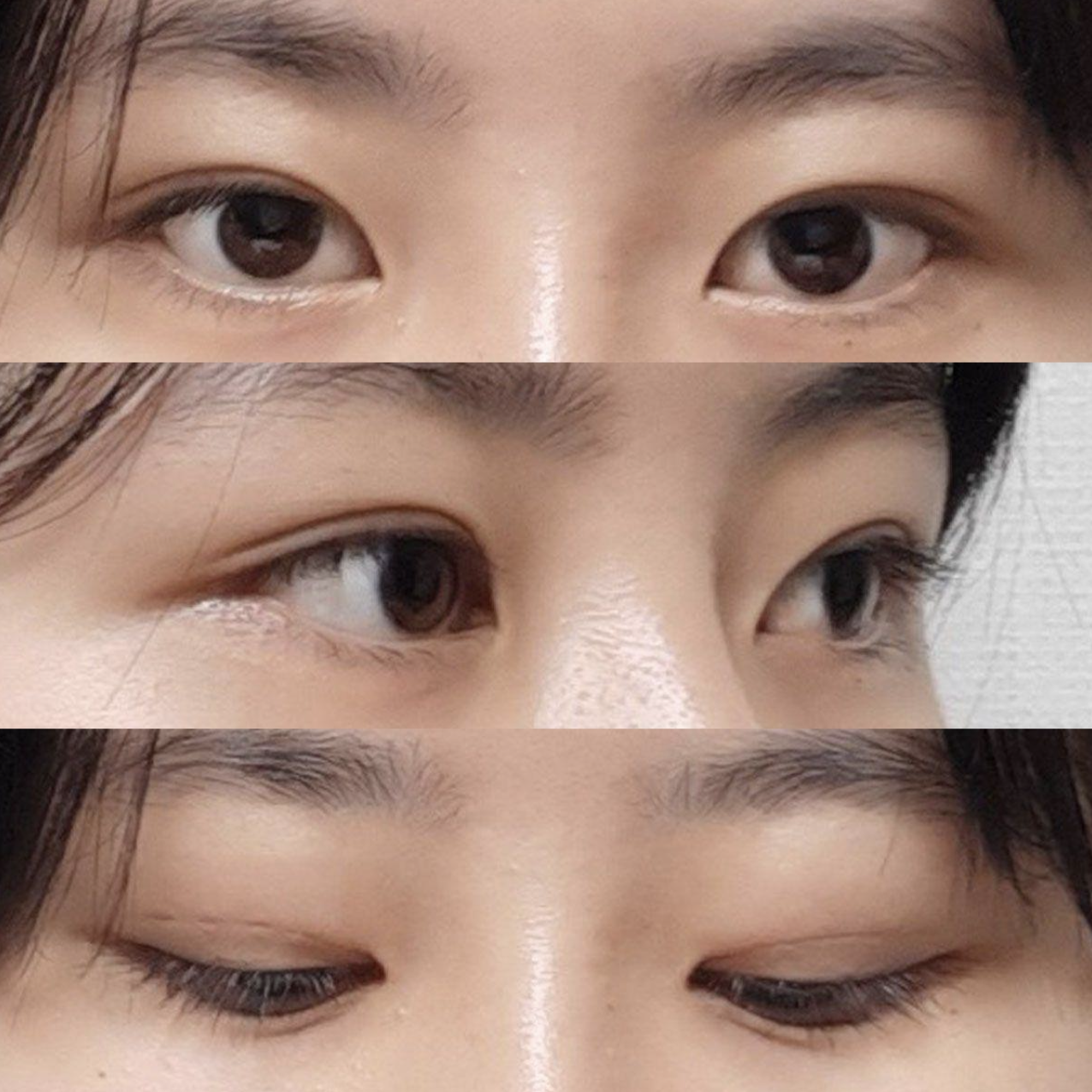 눈도 2주만에 멍이 다 빠지고 흉터, 상처 없이 말끔합니다!