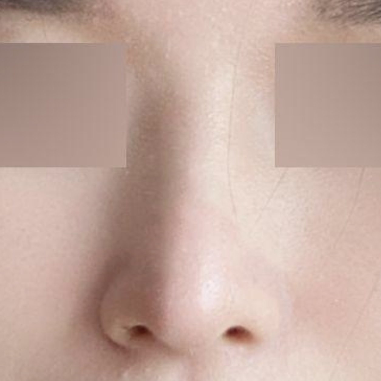 코 수술 받은지 6개월이나 흘렀네요