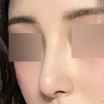 수술 한달차입니다.