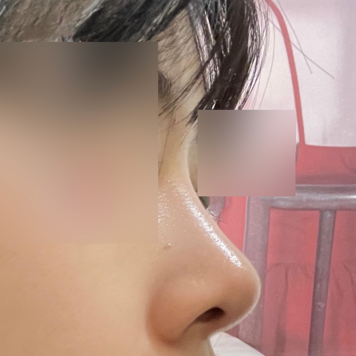 코수술 6개월차 후기 입니다!