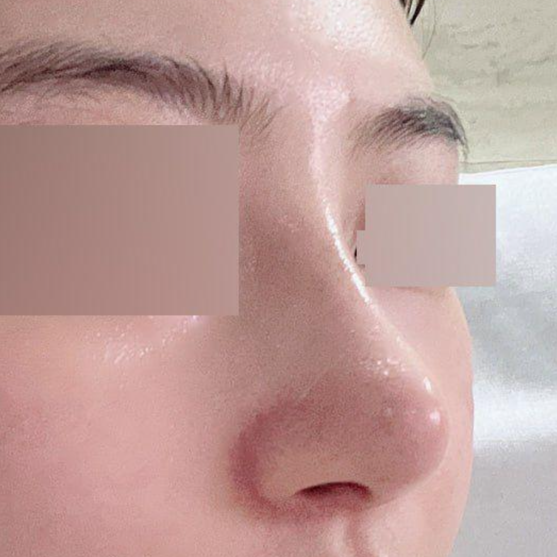 제 워너비 코 만들어주신 서승조원장님 감사합니다!