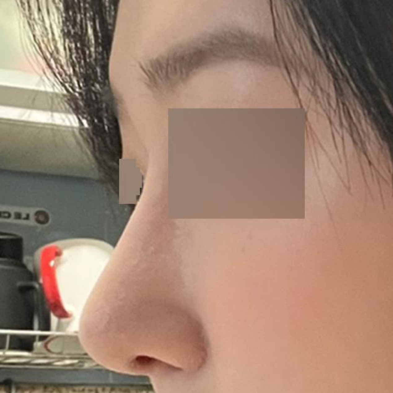 첫코수술에 여기저기 고민하다 드디어 코 수술 하였습니다.