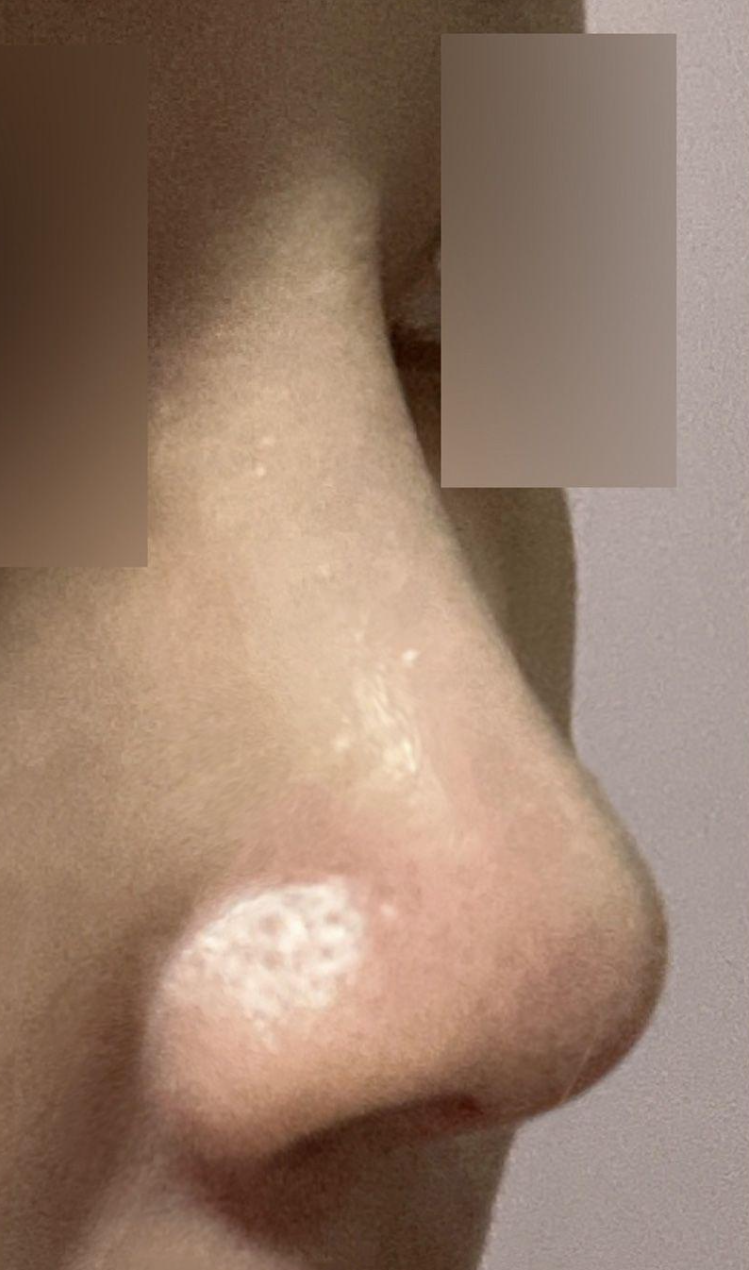 벌써 수술한지 6달지났어요