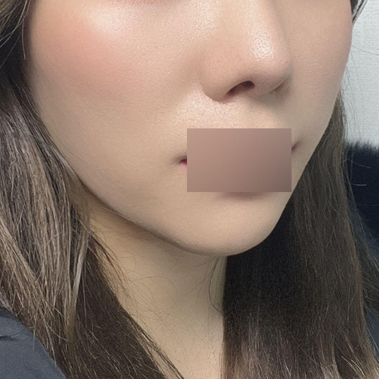 피치 실리프팅 3달차 됐어요