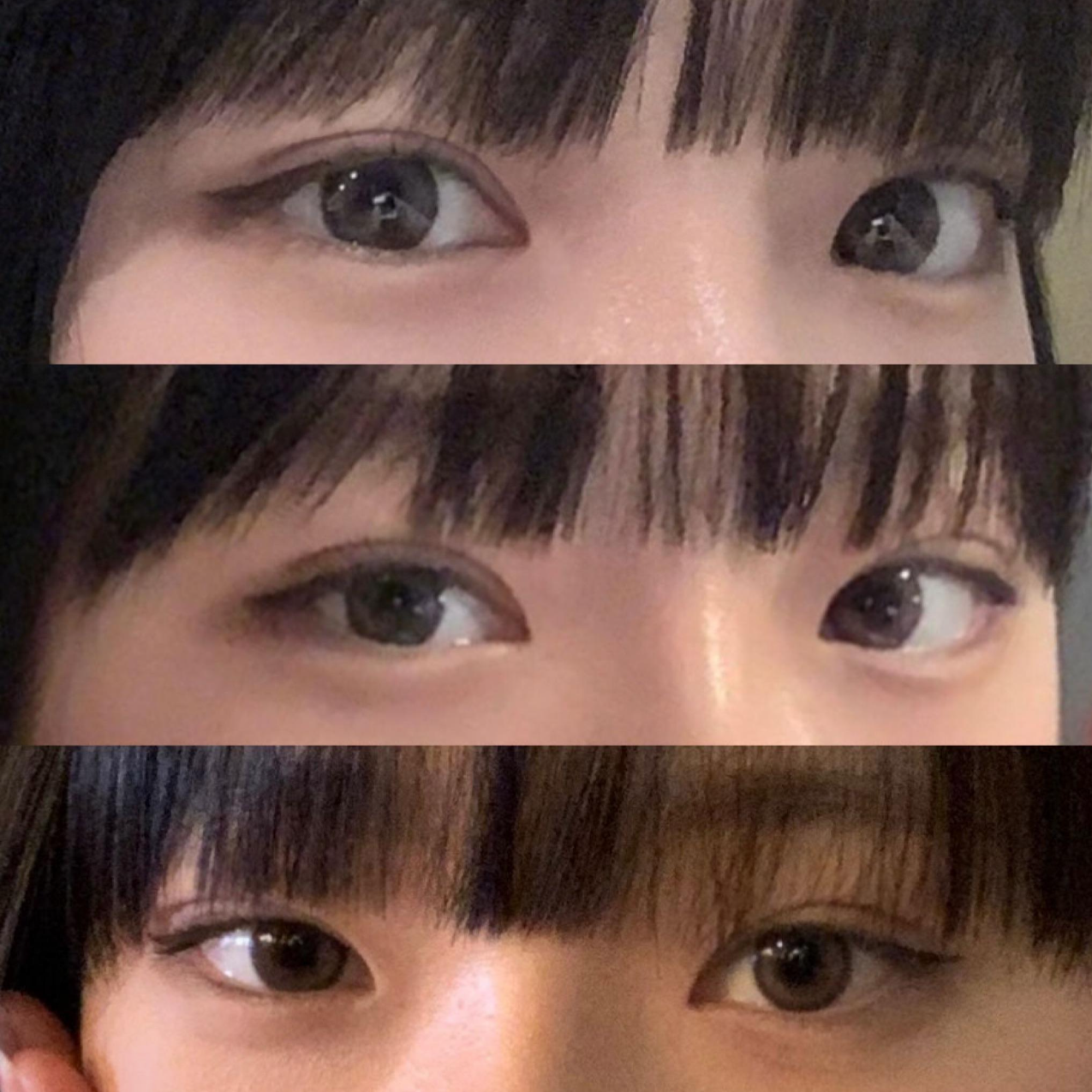 눈 재수술, 코수술 받았습니다!