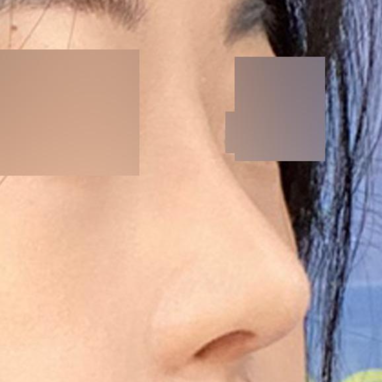 수술한지 2개월 됐는데 너무 만족스러워요.