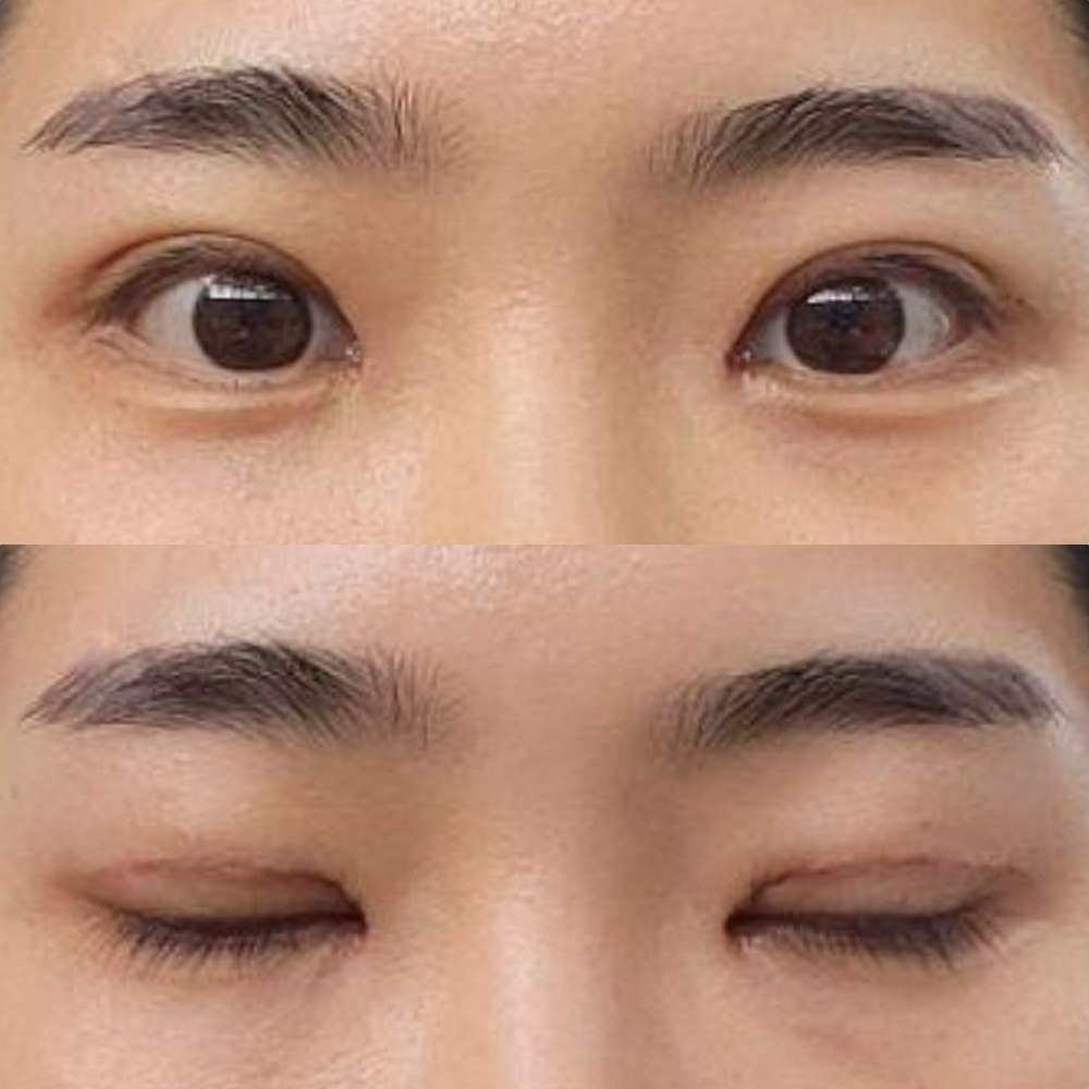 눈재수술 받은지 일주일 됐어요