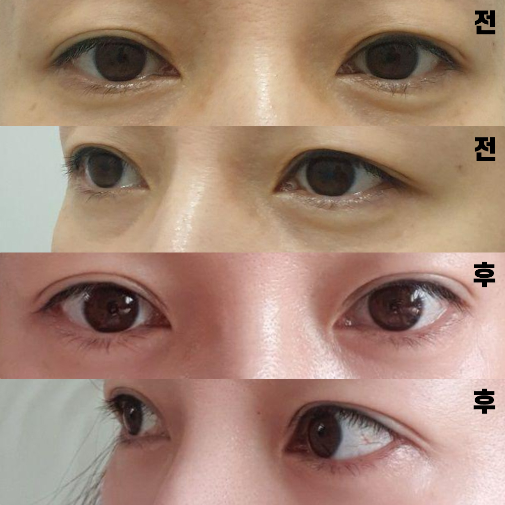 수술 하길 잘했다는 생각 다시 드네요