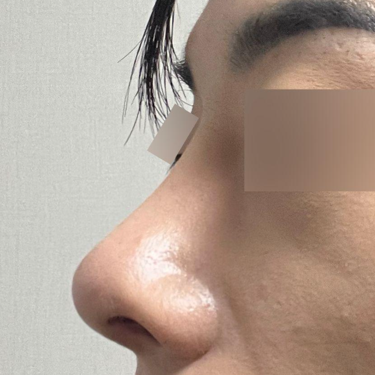 재수술 고민중인분들 심원장님 꼭 가보세요