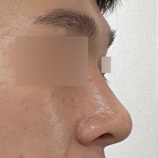 서승조 원장님께 코 수술을 받은 지 2달 차입니다.