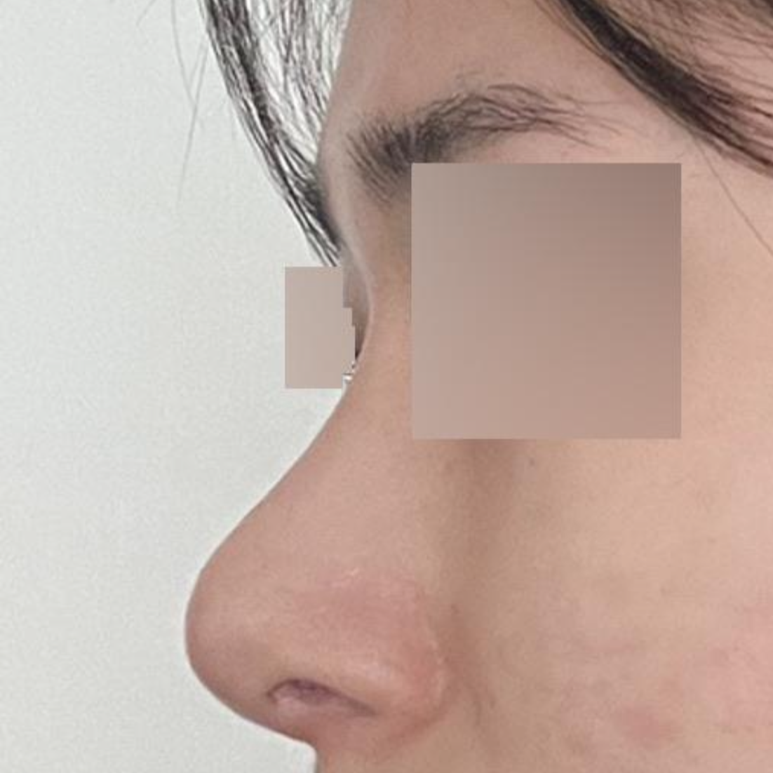 위버스 성형외과 의원에서 코 수술한지 두달 차 입니다.