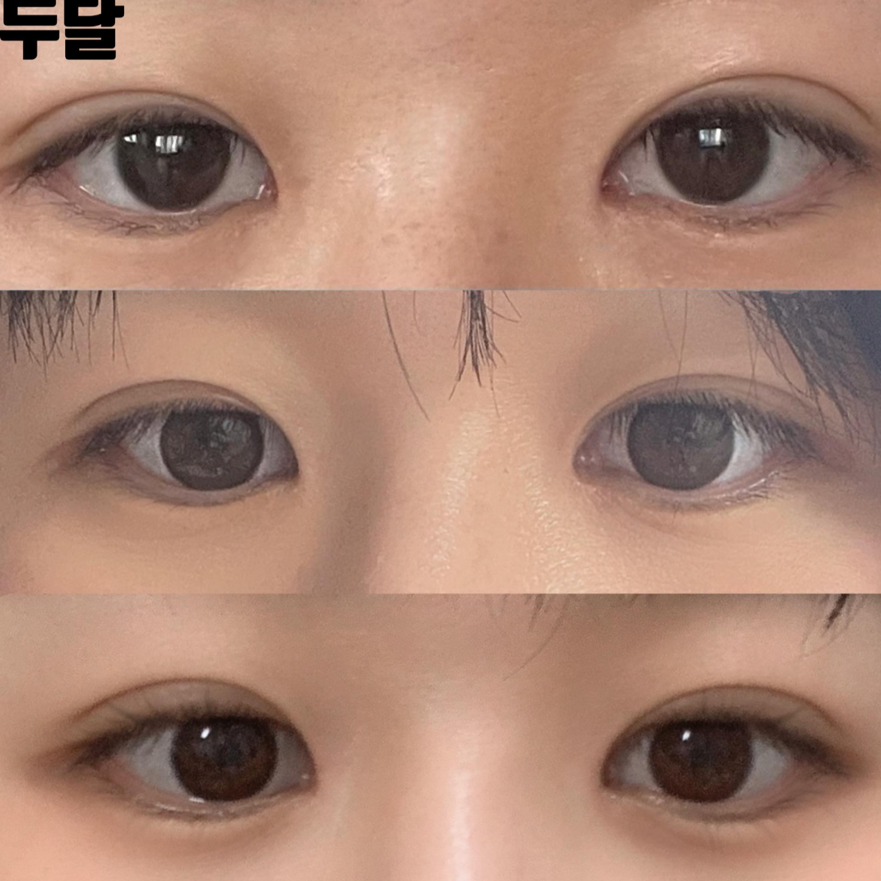 심정환원장님한테 눈코 수술받은지 두달차 후기 남겨요