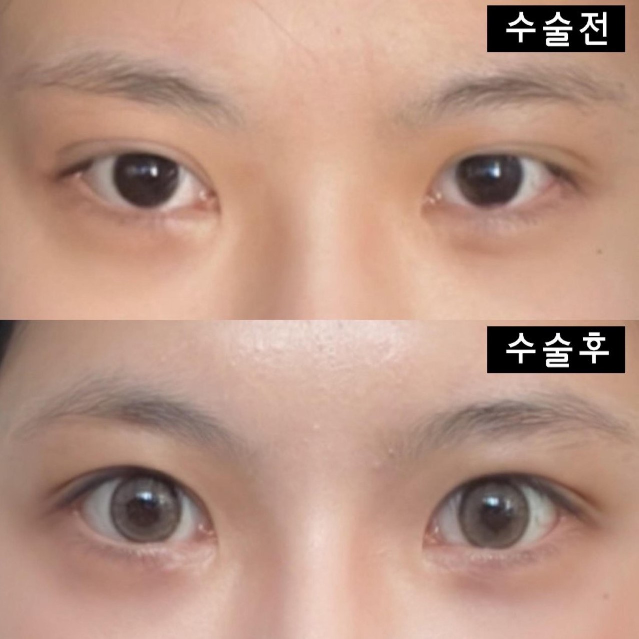 위버스성형외과에서 수술한지 두달째 되는 날이에요~