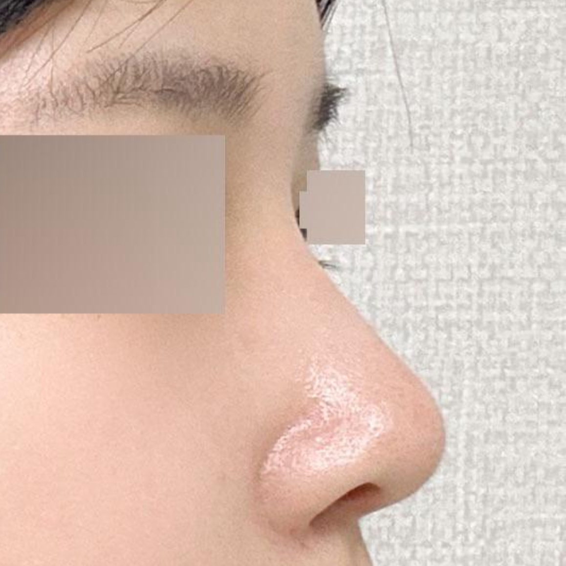 위버스성형외과에서 수술한지 두달째 되는 날이에요~