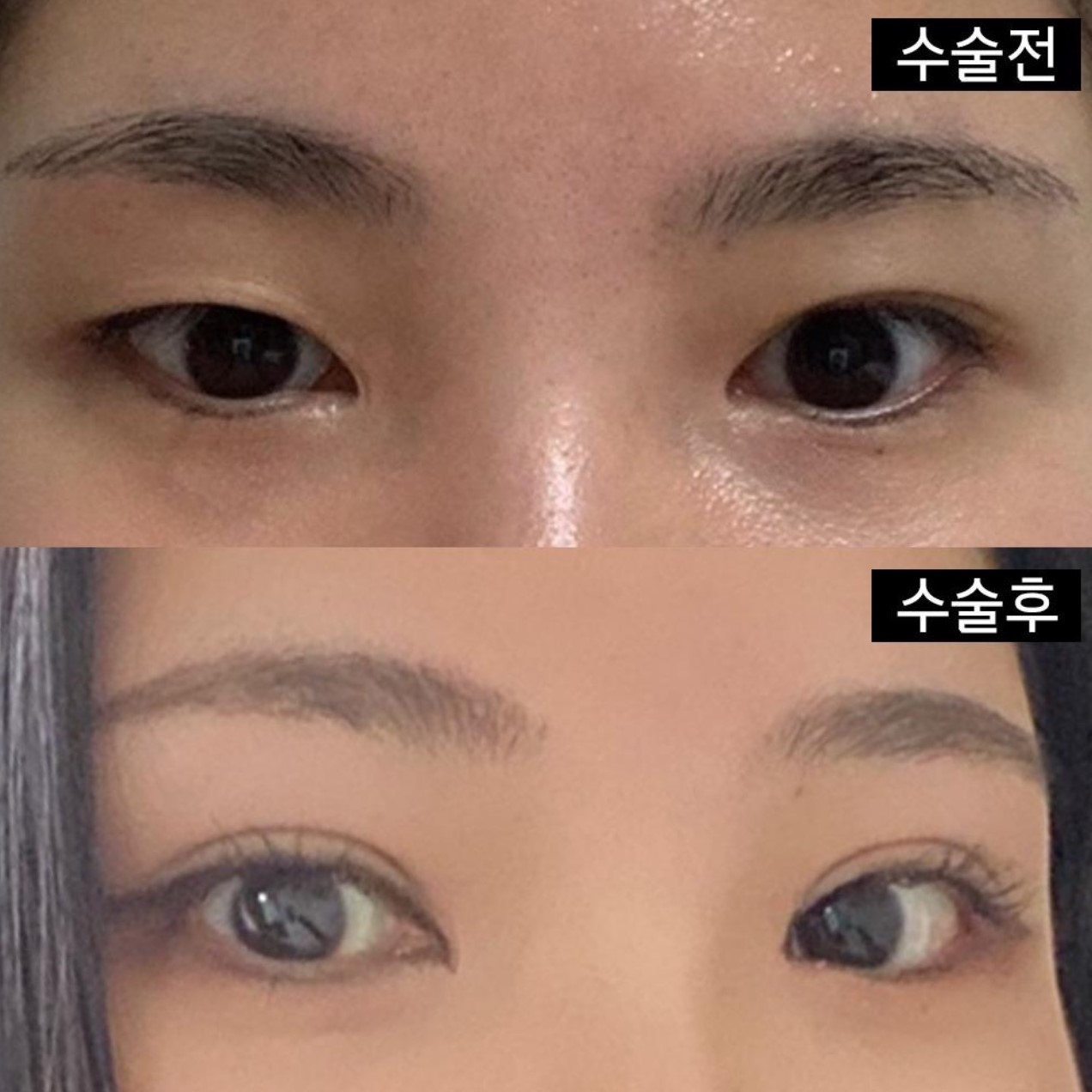 쌍수, 눈재수술이시면 꼭 방문 추천합니다