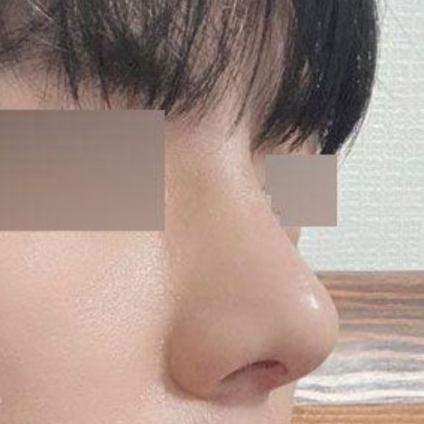 비염 수술겸, 자기 관리겸 수술하게 되었습니다