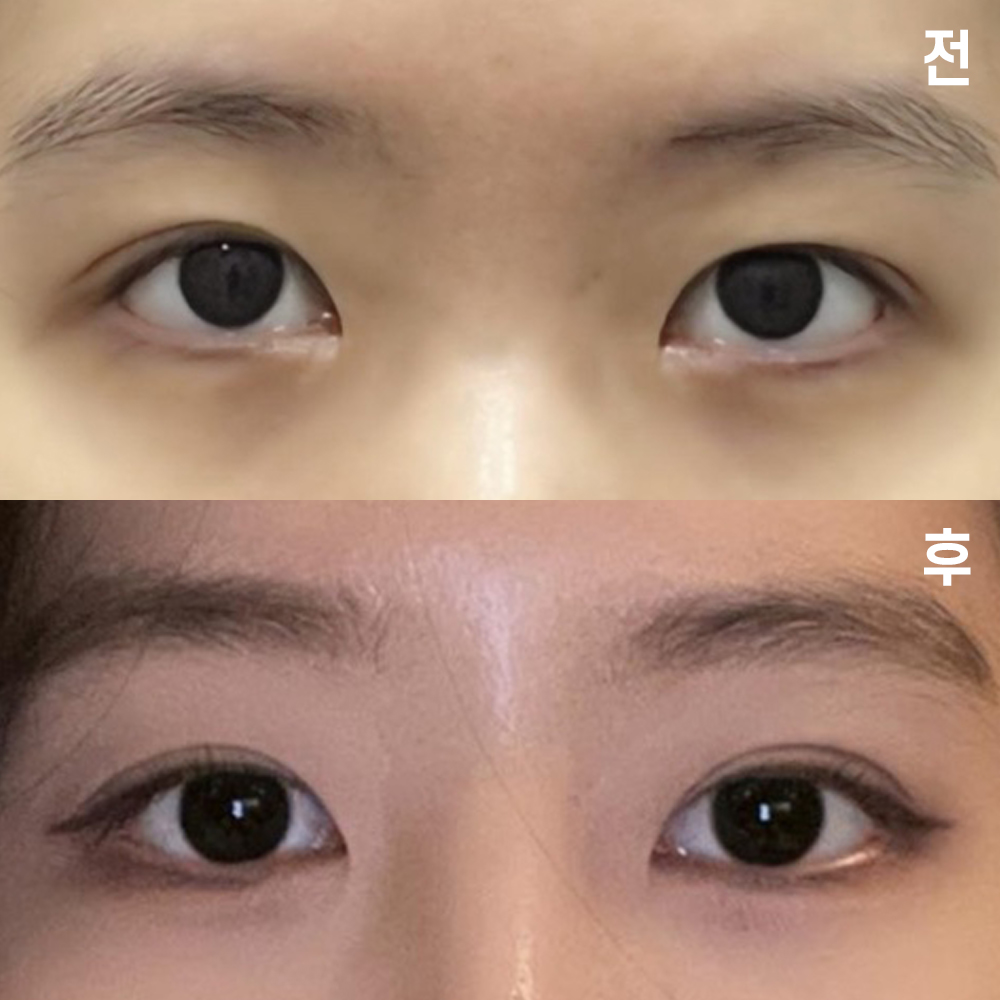 위버스 성형외과에서 수술한 지 1달차 됐어요~!