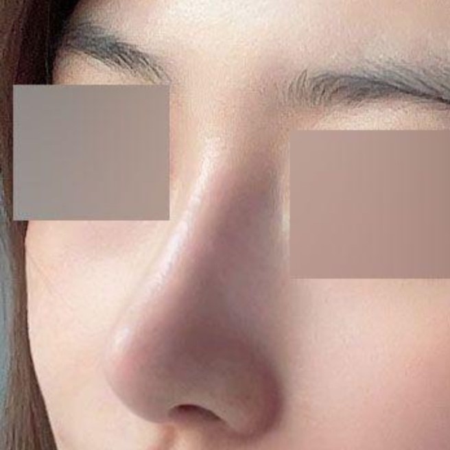 코재수술하고 별일없이 3개월 경과까지 왔네요 ㅎㅎ