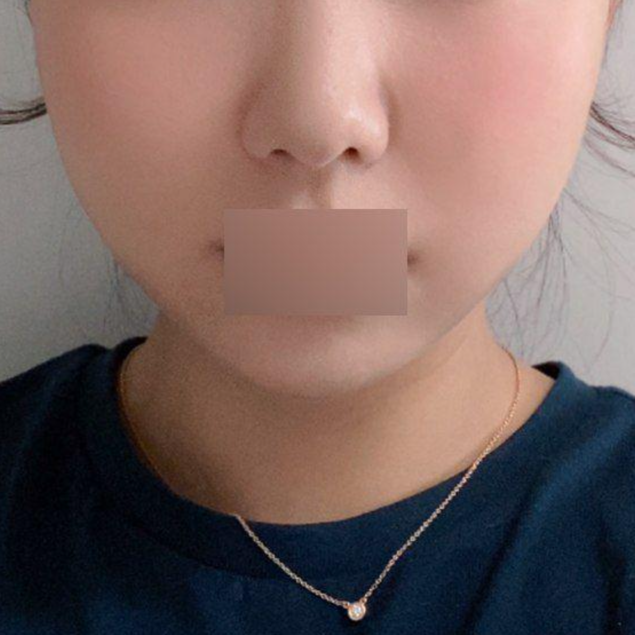 심정환 원장님께 실리프팅 1달 됐어요