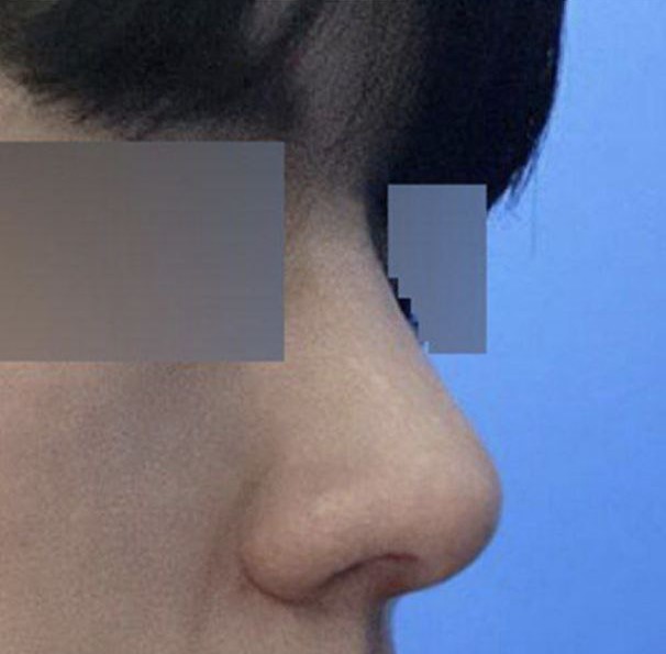 남자는 직선코라고 하는지 이제 이해가 가네요 ㅋㅋㅋ