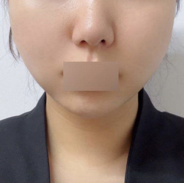 실리프팅으로 받은게 신의 한수였어요