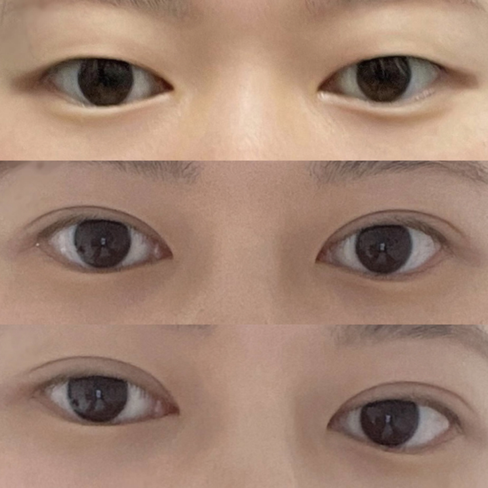 절개로 얇은 라인 성공했어용