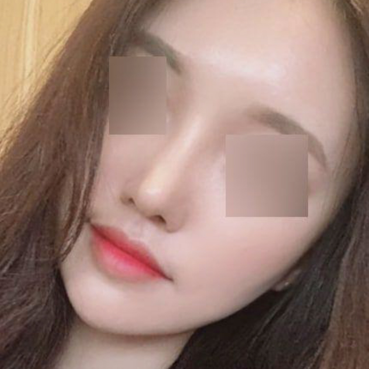 위버스에서 코수술한지 세 달 됐어요!