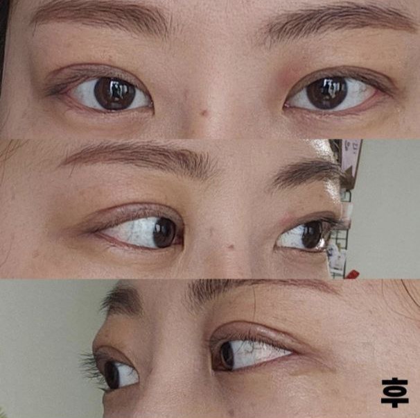 수술하길 정말 잘한것 같아요