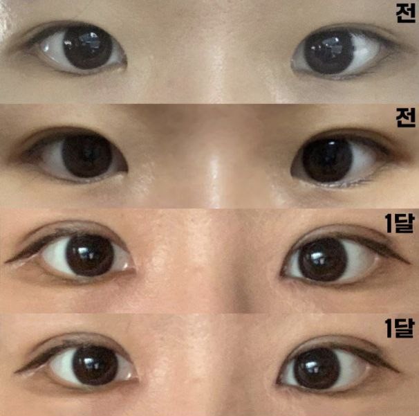 걱정했던거와는 다르게 변화 확실하게 보여서 만족중입니다!