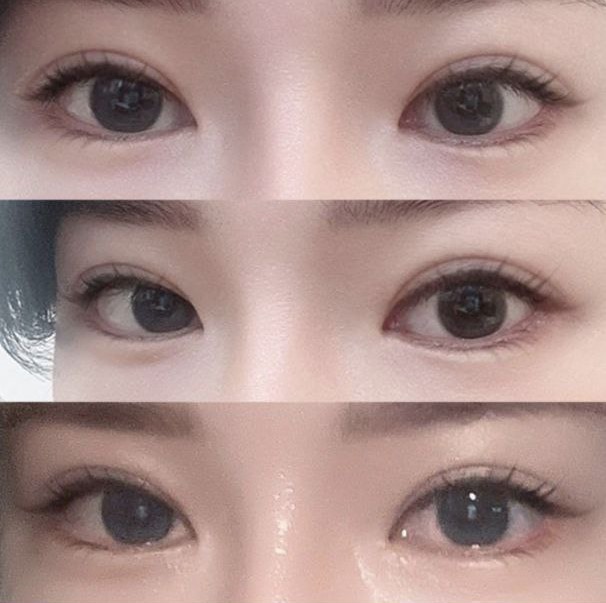 재수술 해야 된다면 다들 위버스 가세요들!! ㅎㅎㅎ