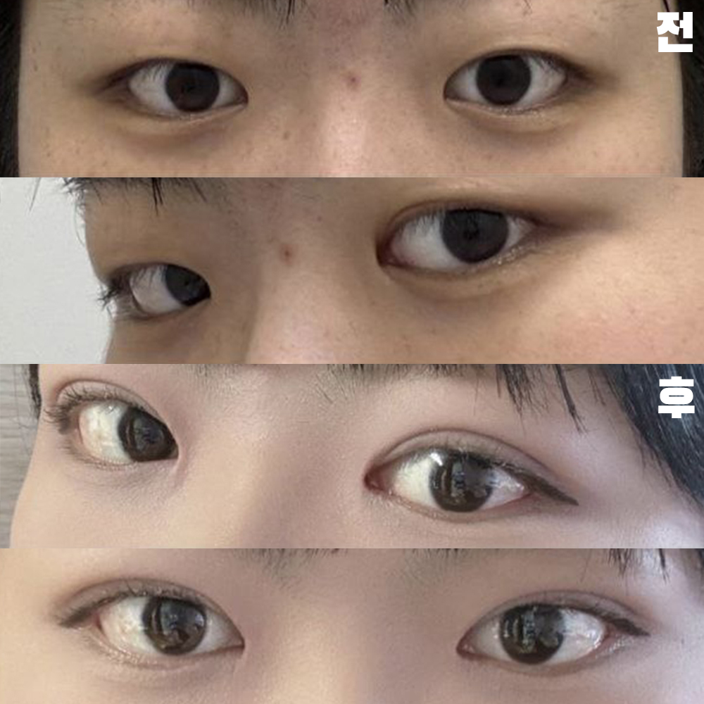 아프지않게 섬세하게 해주셔서 감사했습니다.