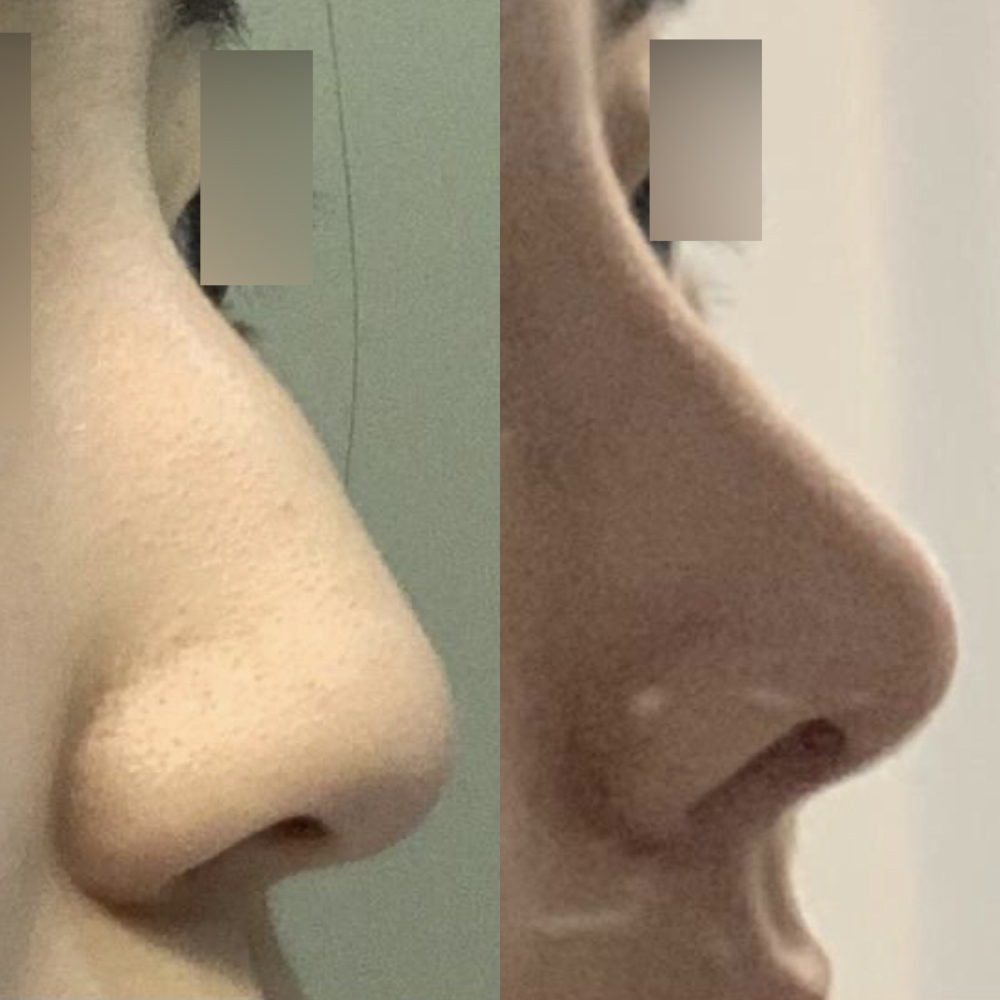 매부리코 수술 받았어요ㅎㅎ