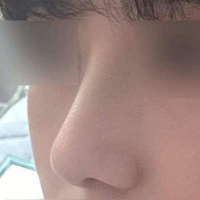 첫 코수술인데도 불구하고 너무너무3728299393829% 만족합니다