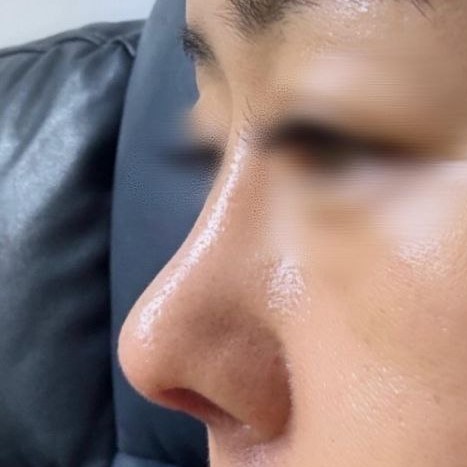 코끝이 뚝 떨어지는게 고민이였는데 코끝이 생겨서 너무 좋네요^^