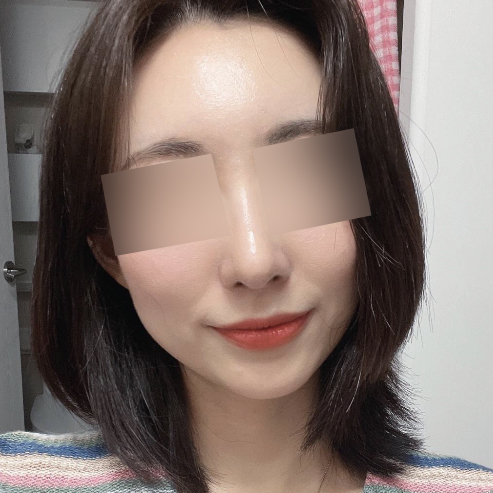 코+이마 자가지방이식 받았어요!!