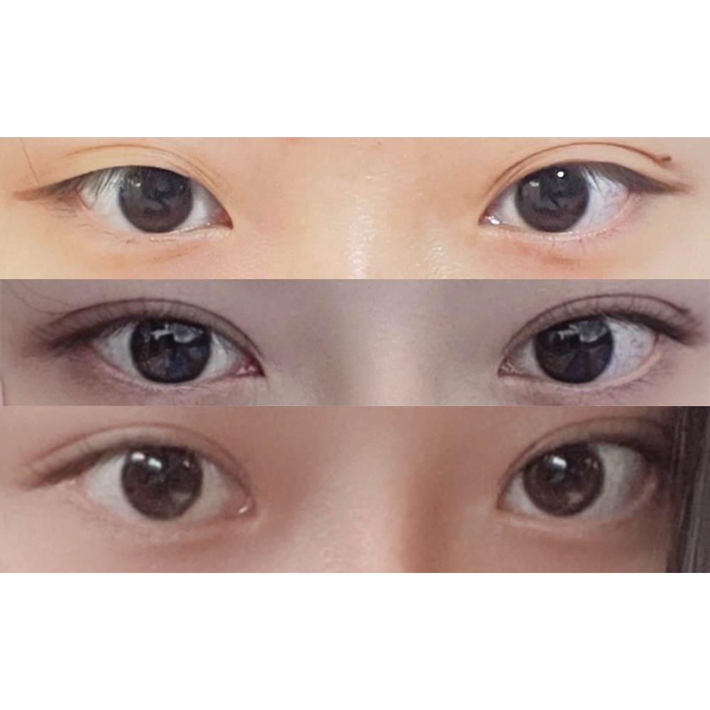 눈, 코 같이 수술 받았어요ㅎㅎ