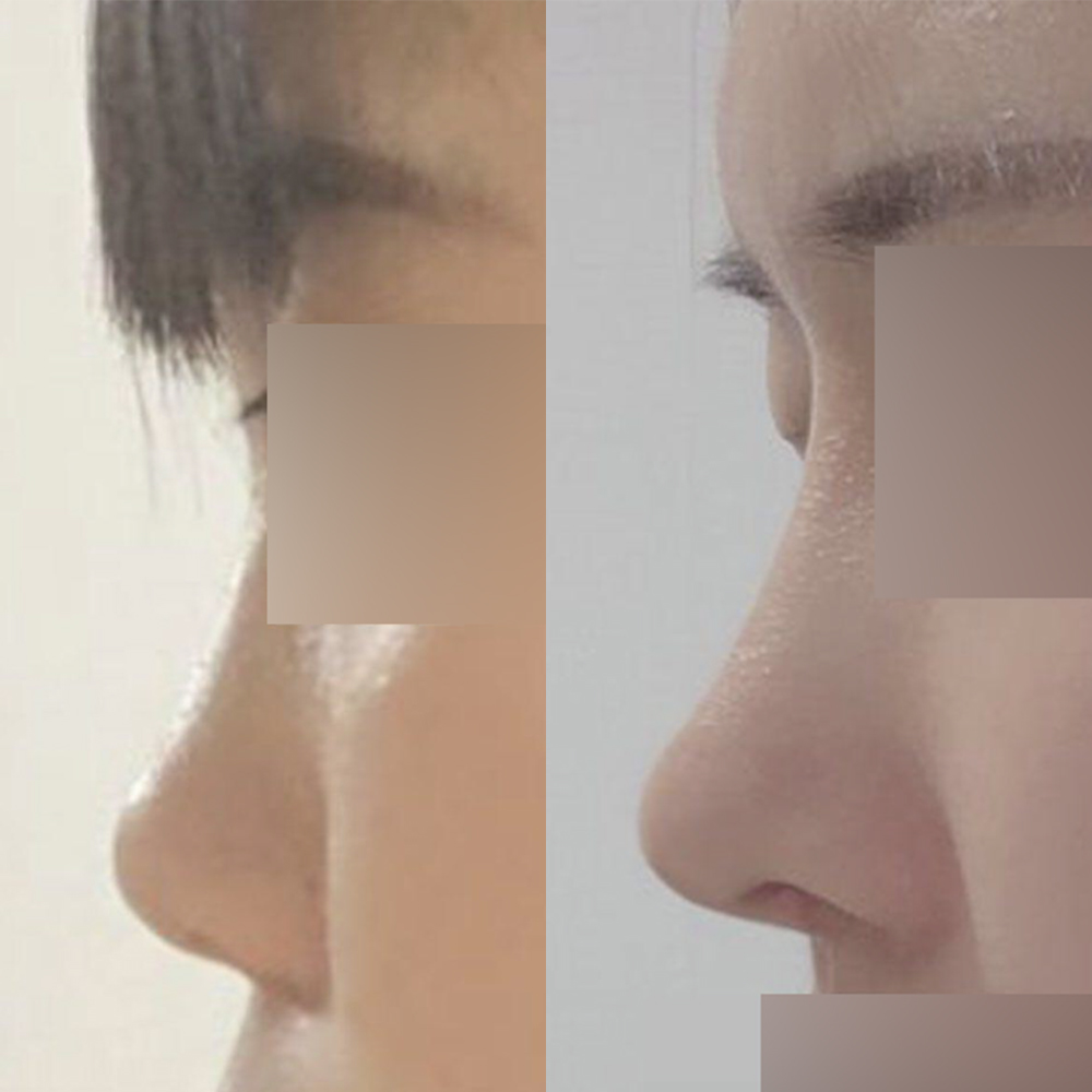 눈코수술 받은지 벌써 8달 됐어요!