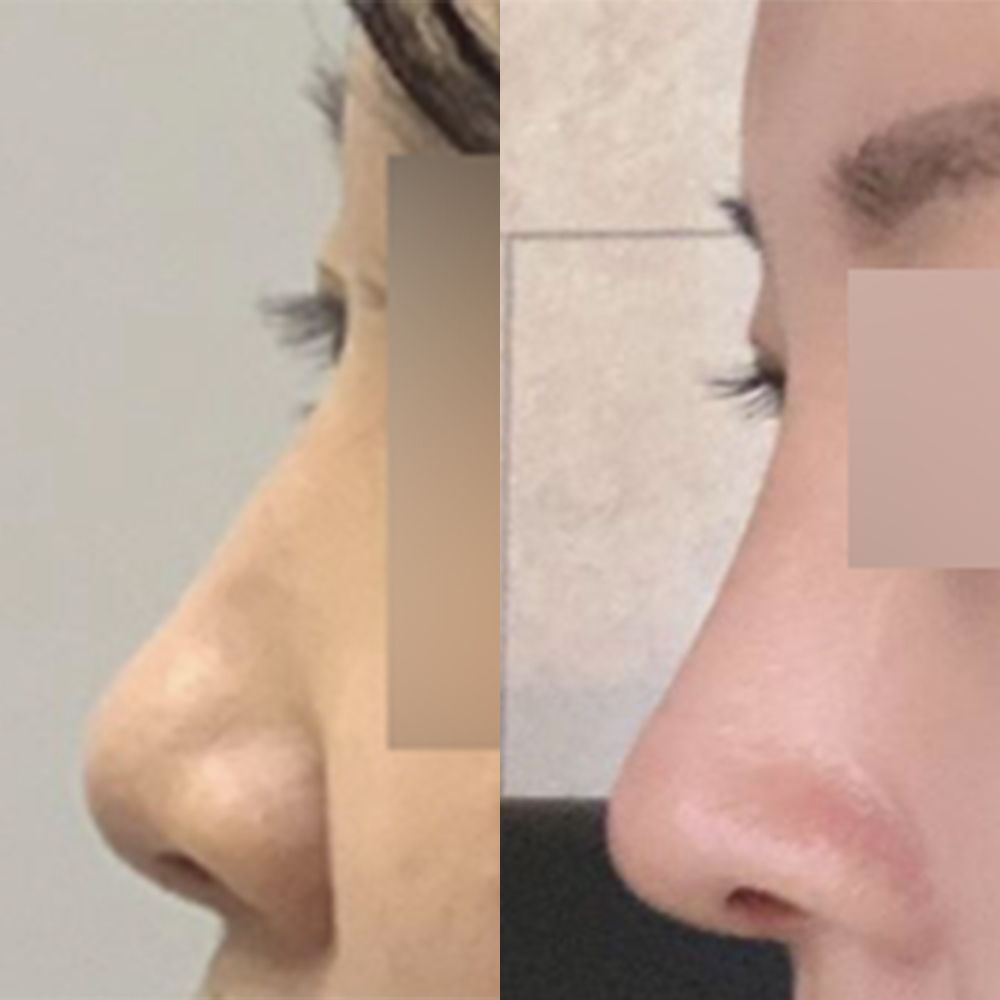 첫 코 수술 받았습니당!