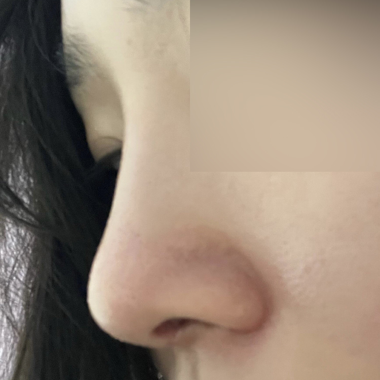 위버스 심정환 원장님께 7월 초에 수술 받았어요!