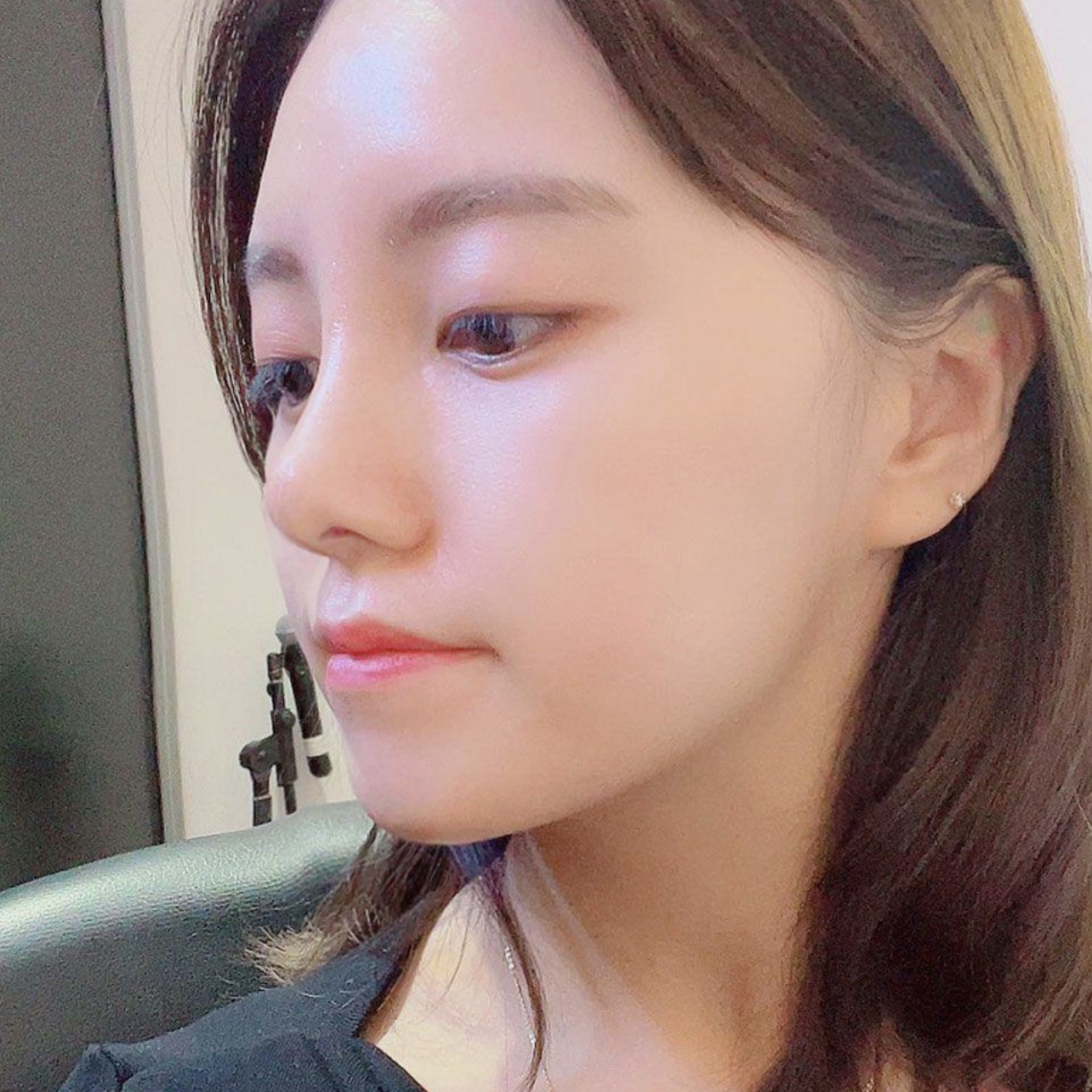 위버스 성형외과에서 코수술한지 1달차에용