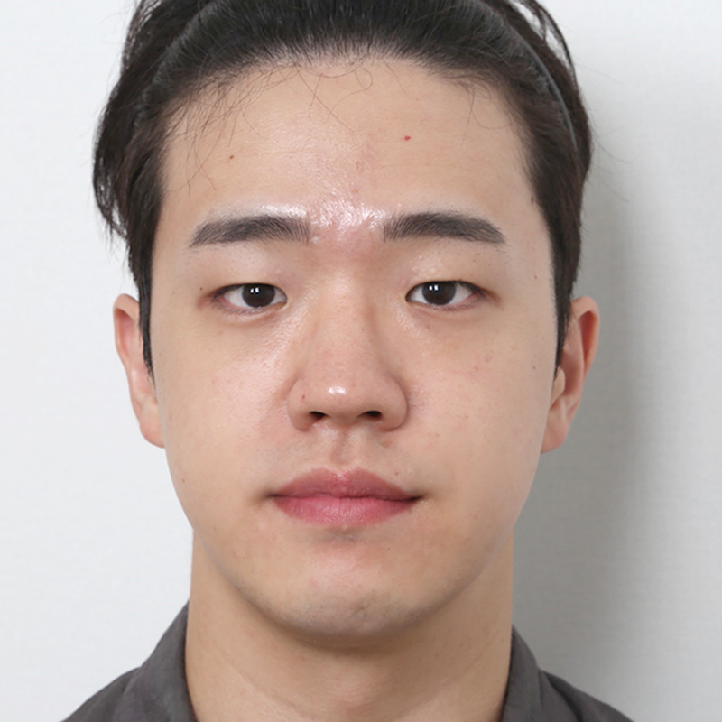 #부분절개 #눈매교정 #콧대(실리콘) #코끝(자가연골)