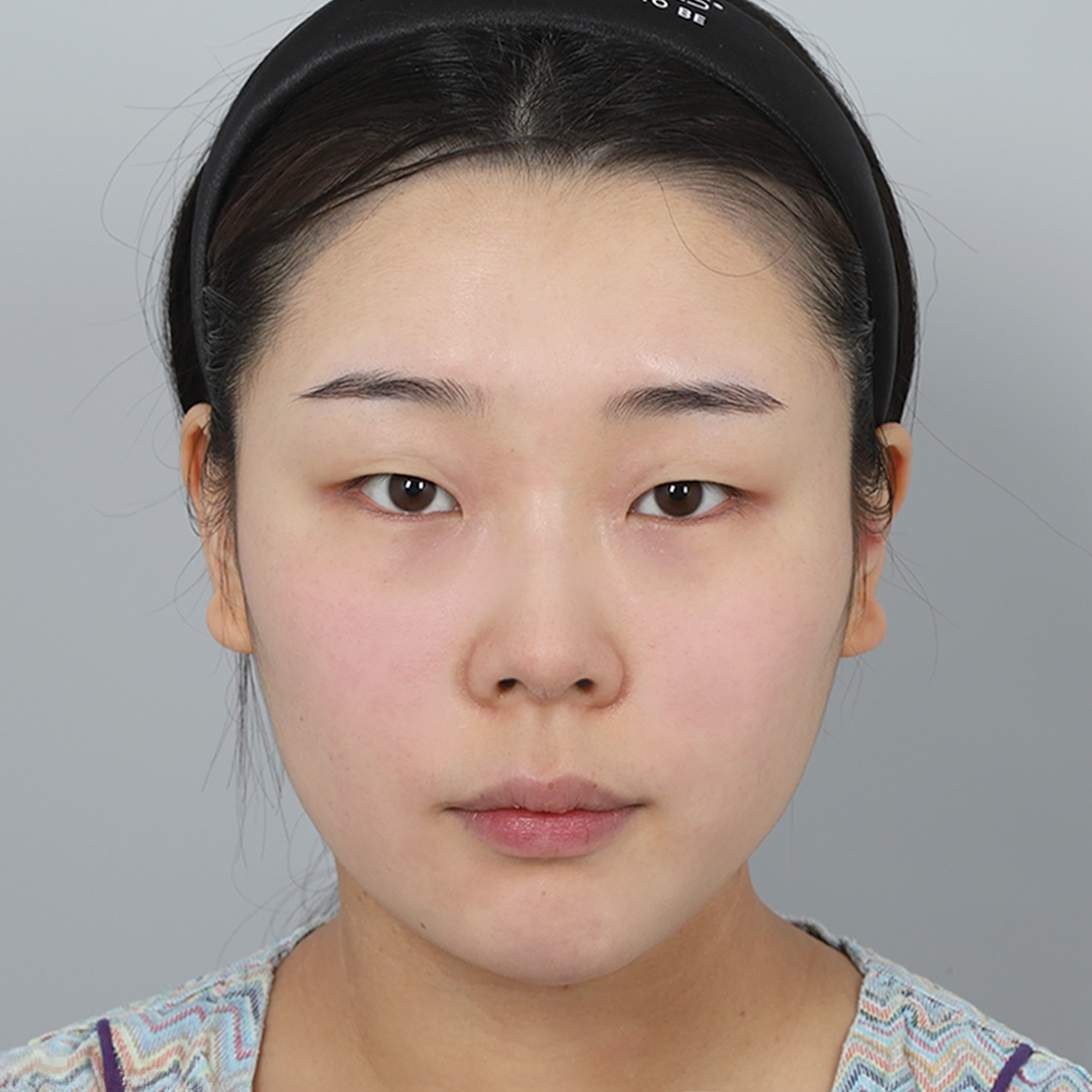 #부분절개 #윗트임 #눈위지방제거 #콧대(실리콘) #코끝(자가연골)