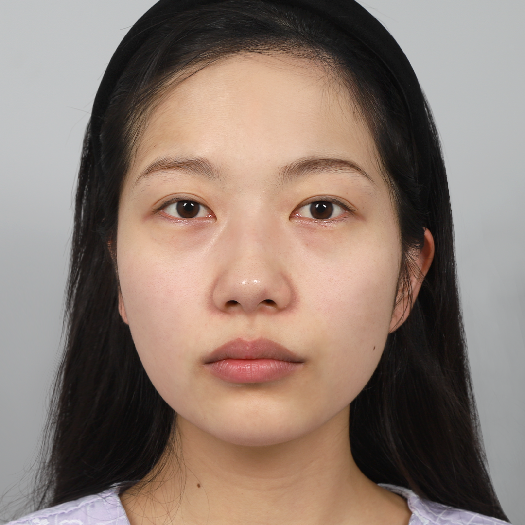 #부분절개 #윗트임 #무보형물코성형 #코끝(자가연골) #매부리코 교정눈재수술