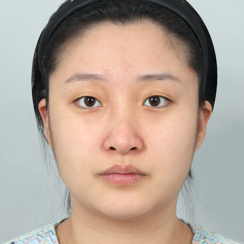 #부분절개 #코끝(자가연골) #무보형물코성형 #매부리코 교정화살코교정