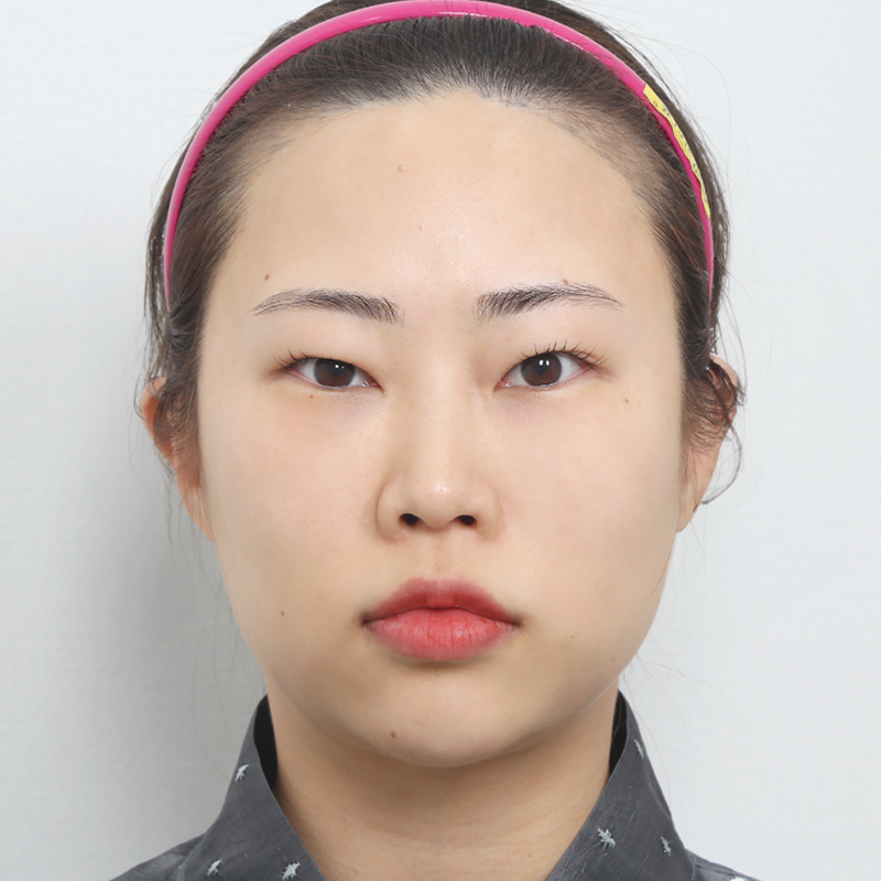 #부분절개 #윗트임 #뒤밑트임 #눈위지방제거 #콧대(실리콘) #자가늑 코성형