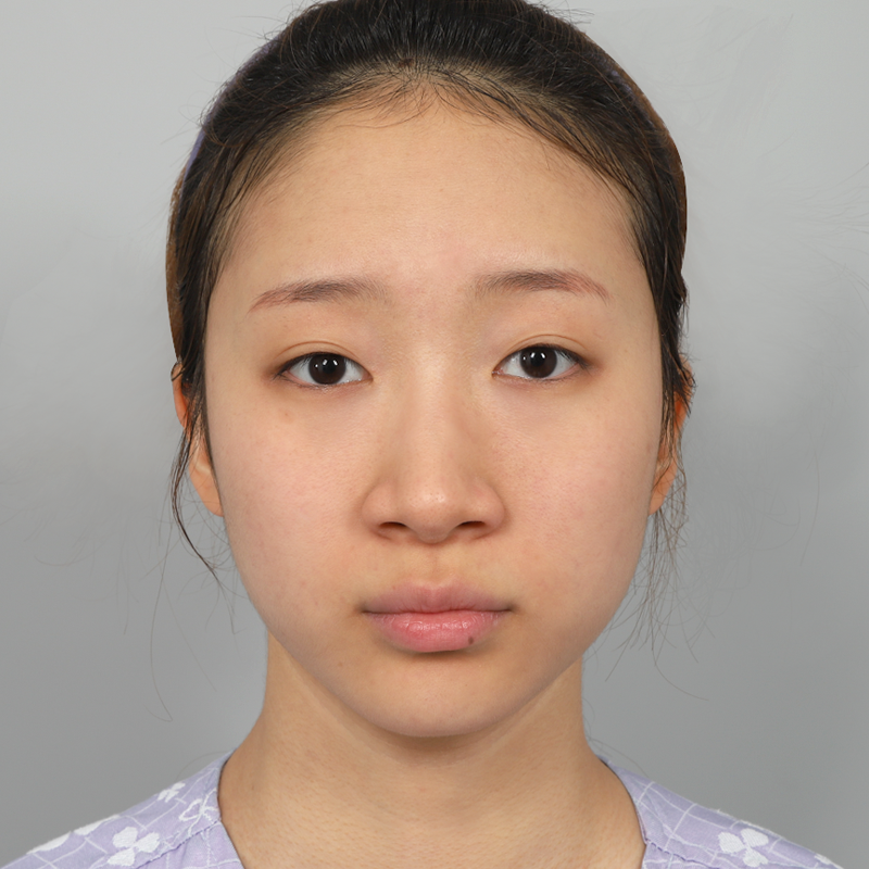 #콧대(실리콘) #코끝(자가연골) #콧볼 축소