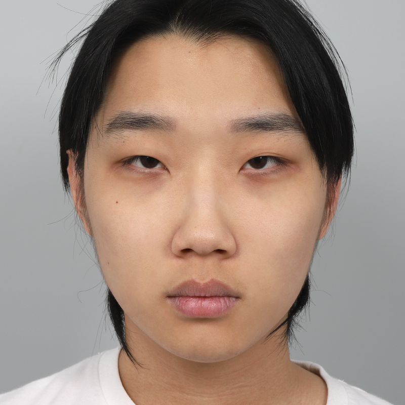 #부분절개 #눈매교정 #콧대(실리콘) #코끝(자가연골) #콧볼 축소