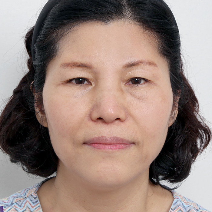 #하안검 #이마거상(엔도타인)안면거상