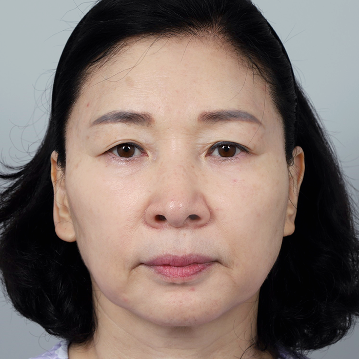 #상안검 #하안검눈썹하거상안면거상