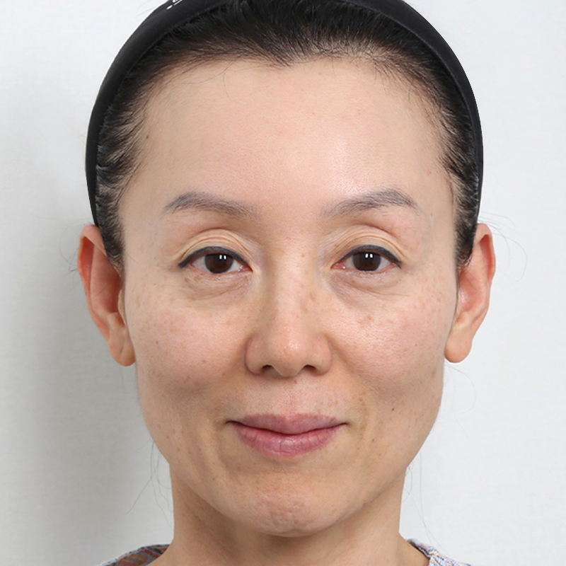 #눈위지방이식 #하안검풀페이스 지방이식